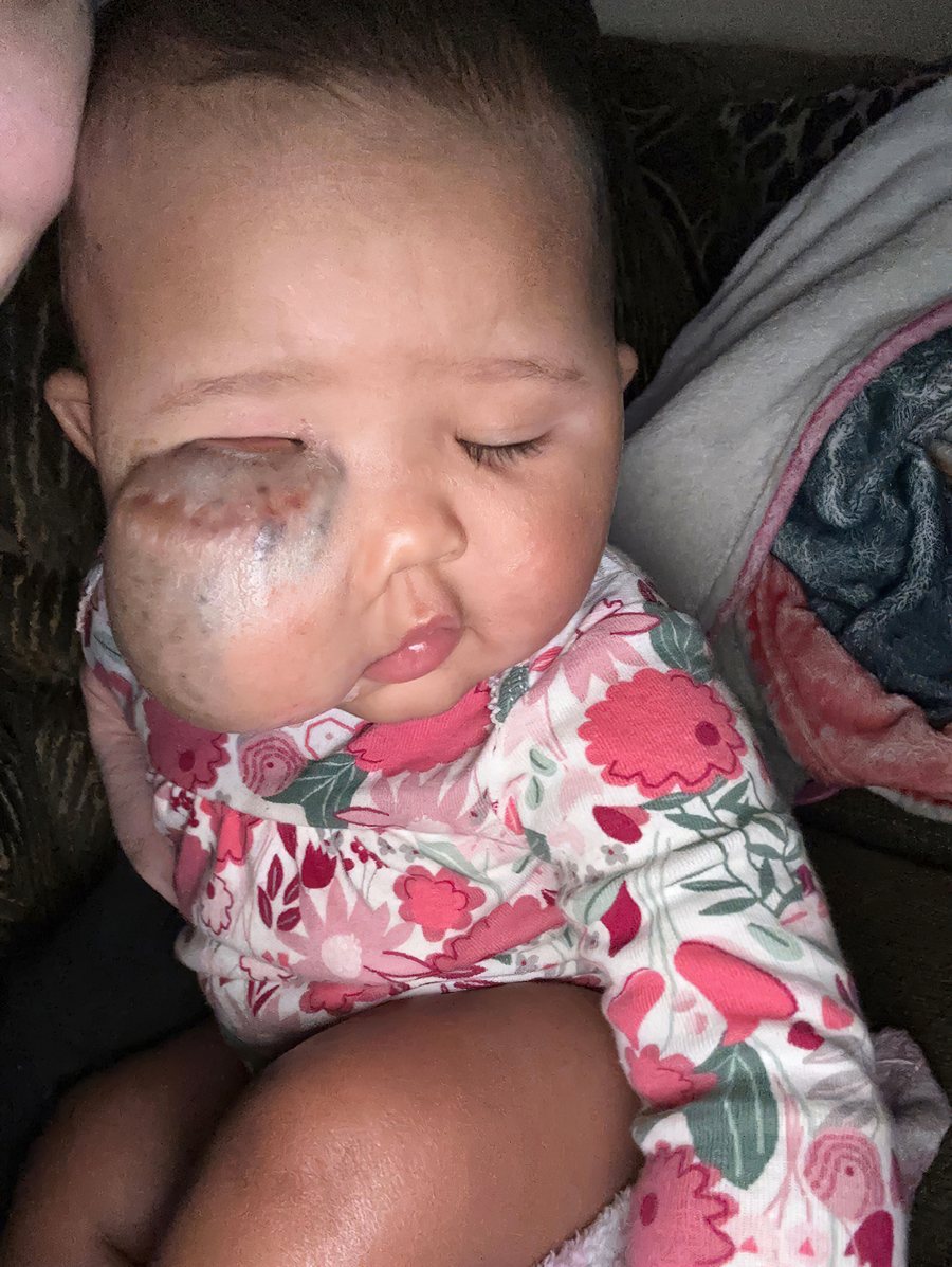 Caylani, who had surgery at seven months old